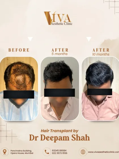 See the journey, not just the result. This collage shows the progress from the day of the procedure to early growth at 5 months, and the final dense, natural look at 10 months. Good things take time, and I am with you at every step.