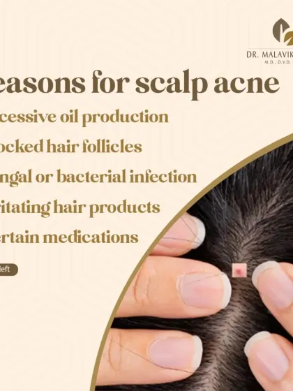 The reasons for scalp acne are varied. They include excessive oil production, blocked hair follicles, fungal or bacterial infections, irritation from hair products, and in some cases, reactions to certain medications.