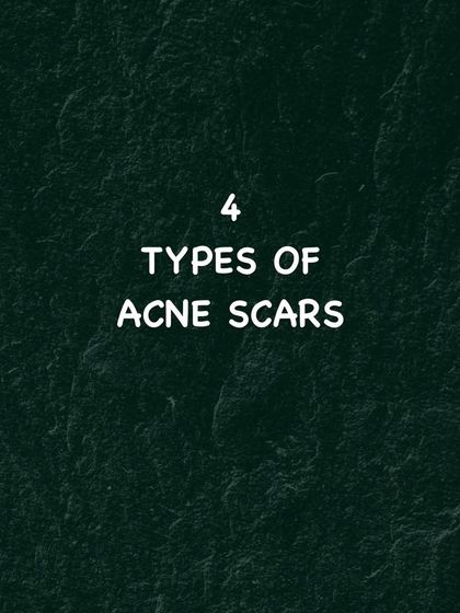 A closer look at the four primary categories of acne scars. Identifying whether you have ice pick, boxcar, rolling, or hypertrophic scars is crucial for effective treatment.