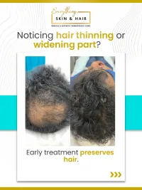 Hair Restoration & Laser Hair Removal