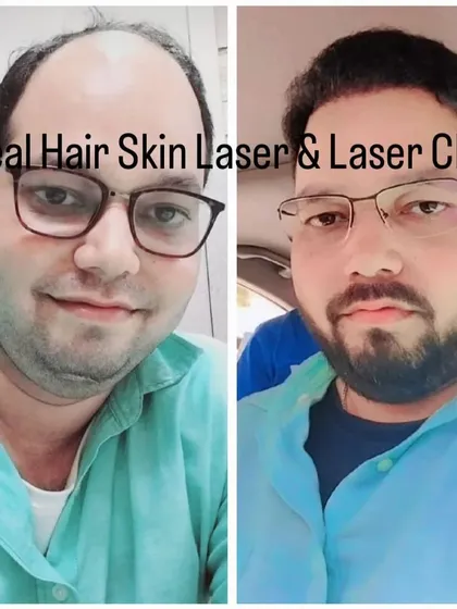 This before and after photo shows a remarkable improvement in hair density and coverage for a patient who was experiencing male pattern baldness.