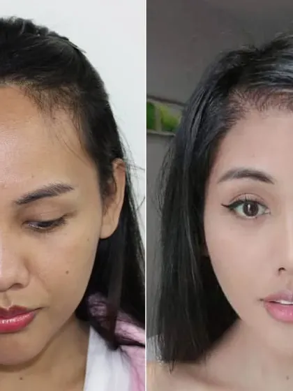 I also specialize in hair restoration for women, including hairline lowering. This patient was concerned about a naturally high forehead. Through a carefully planned transplant, I advanced her hairline, creating a more balanced and feminine facial proportion.