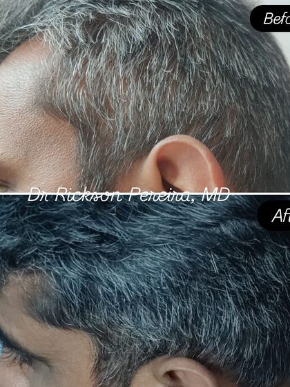 A side view of the same patient, illustrating how a structured treatment plan can restore hair volume and create a fuller appearance. Great results are a product of medical science and patient dedication.