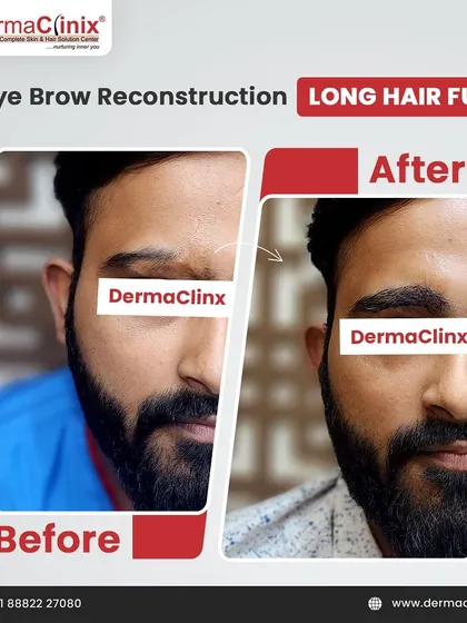Hair restoration is not just for pattern baldness. This image shows a successful eyebrow reconstruction using our Long Hair FUE technique for a patient who lost their eyebrow hair due to an accident. We restored not just the eyebrow, but also their confidence.