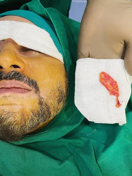 Here you see a patient immediately after buccal fat removal, with the extracted fat pad shown for context. The procedure is straightforward and performed under local anesthesia to achieve a more contoured cheek and jawline area.