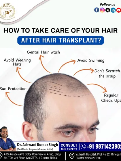 Your journey doesn't end after the procedure. Proper post-transplant hair care is crucial for the best results. I guide all my patients on important steps like gentle washing, sun protection, and avoiding scalp irritation to ensure healthy growth.