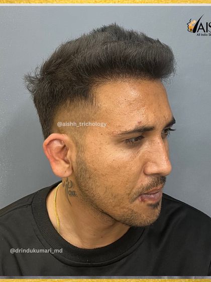 A side view of the final result, highlighting the natural flow and density of the transplanted hair.