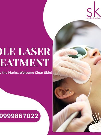 Laser Removal: Moles, Warts & Tags photo 3