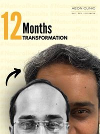 Hair Restoration & Treatment