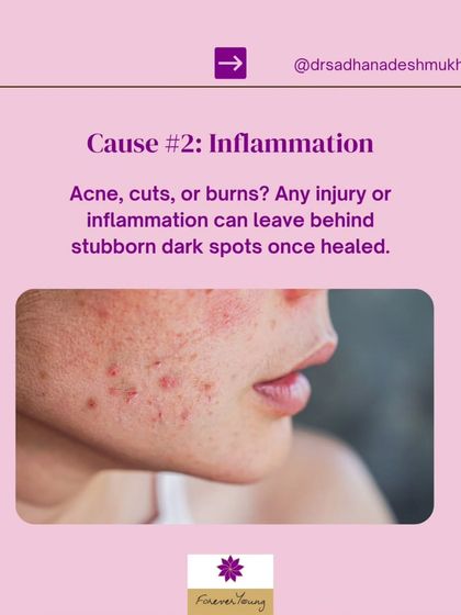 Any form of skin inflammation, whether from acne, cuts, or burns, can leave behind stubborn dark spots after the initial injury has healed. This is known as post-inflammatory hyperpigmentation (PIH).