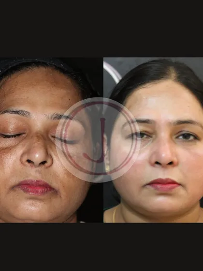 A clear before-and-after of a patient treated for hyperpigmentation. We used a series of depigmenting peels without any harsh steroids to safely lift away dark spots and reveal healthier skin.