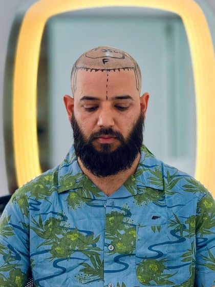 A patient looking down, showing the detailed markings for his hair transplant. This precision is key to our natural looking results.