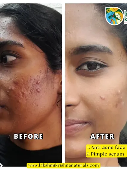 Dealing with acne can be tough, but the right care makes all the difference. This is the result of consistently using our Anti-Acne Face Wash and Pimple Serum. Our goal is to provide solutions that deliver clear, visible results.