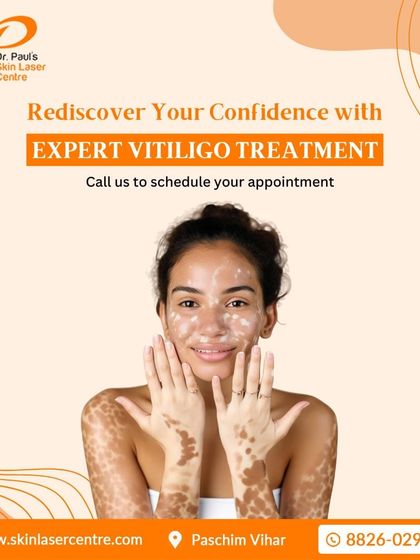 Rediscovering your confidence is a key part of the treatment journey. I offer expert vitiligo treatment designed to help you achieve clear, healthy skin and feel good about yourself.