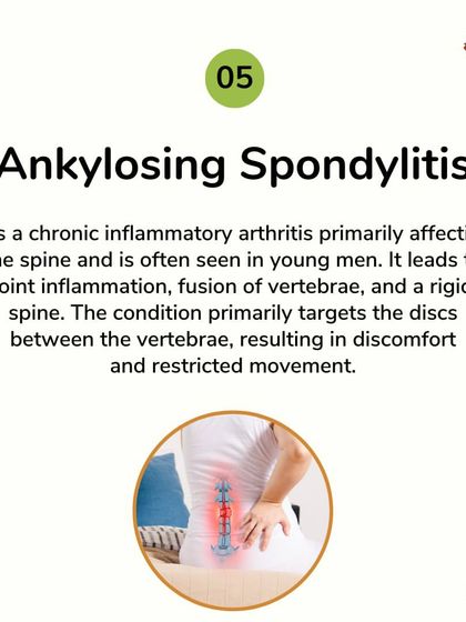 Ankylosing Spondylitis is an inflammatory arthritis affecting the spine. My therapies are designed to reduce inflammation, prevent the fusion of vertebrae, and improve the flexibility of the spine for better comfort and movement.