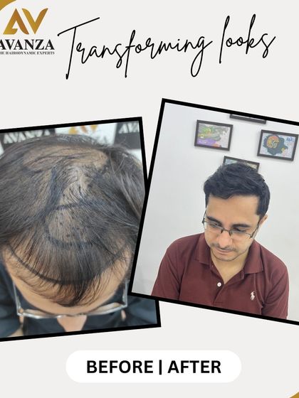 A great result for this client, who now has a fuller hairline and increased density on top. The after photo shows him with a stylish, confident look.