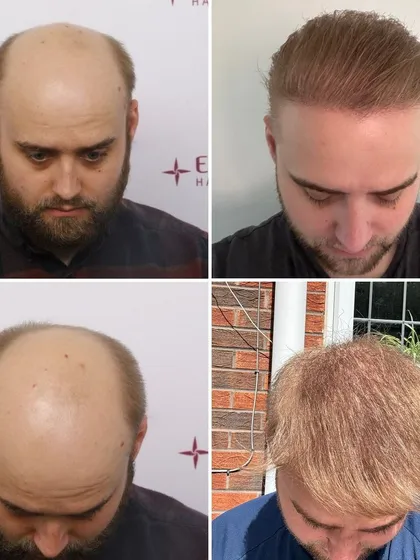 This four-panel image documents one of our most comprehensive transformations, taking a patient from advanced Grade 7 baldness to a full head of hair. This case shows that even with extensive hair loss, remarkable results are achievable.