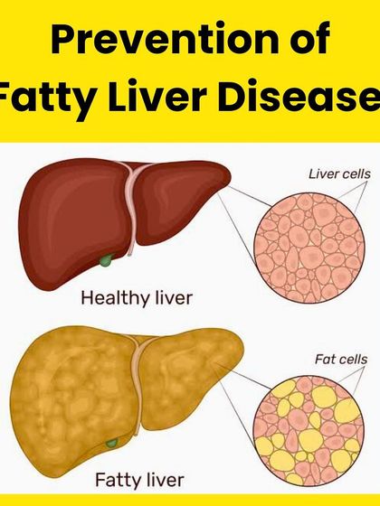 Here are 14 actionable strategies to prevent and reverse fatty liver disease. My approach includes managing weight, adopting a nourishing diet, increasing physical activity, and even leveraging the benefits of black coffee.