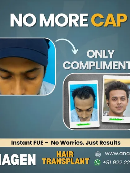 This transformation is a testament to our Instant FUE method. We help patients leave their caps behind and embrace a new life filled with confidence and compliments.