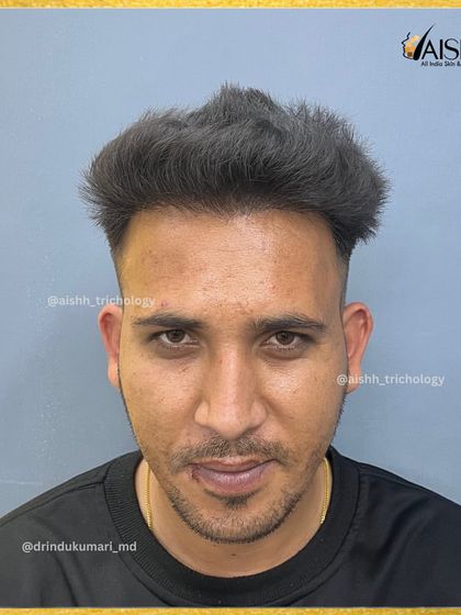 The 'after' result. This frontal view shows a completely restored hairline and impressive density 7 months after the FUE-DHT procedure.
