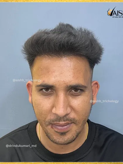 The 'after' result. This frontal view shows a completely restored hairline and impressive density 7 months after the FUE-DHT procedure.