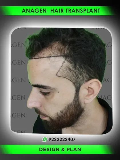 A side profile view of the hairline design and planning phase. We take great care to ensure the new hairline will perfectly frame the face and blend seamlessly with existing hair.