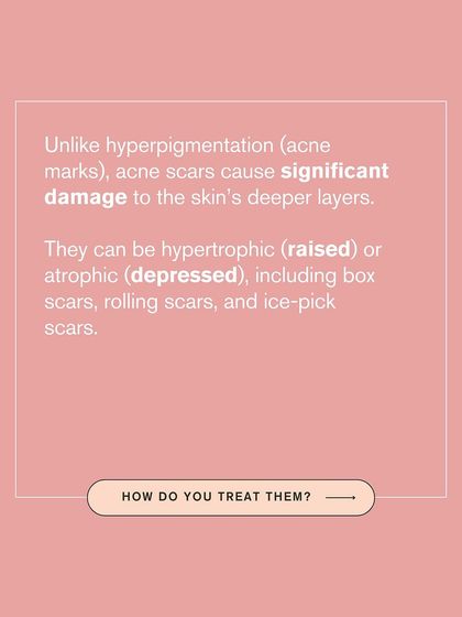 Unlike superficial acne marks, acne scars cause significant damage to the skin's deeper layers. They can be raised (hypertrophic) or depressed (atrophic), requiring specific treatments.