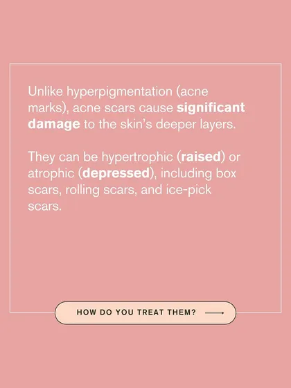 Unlike superficial acne marks, acne scars cause significant damage to the skin's deeper layers. They can be raised (hypertrophic) or depressed (atrophic), requiring specific treatments.