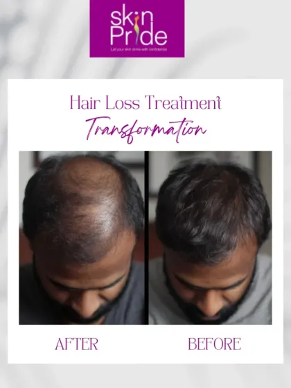(Hero Media) Here is a real transformation from one of our clients. We focus on delivering visible results that not only restore hair but also bring back confidence, strand by strand. This is what our hair loss treatment journey can achieve.