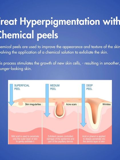 This diagram illustrates how chemical peels work at different depths. A superficial peel gently exfoliates the top layer, a medium peel reaches deeper to address issues like acne scars, and a deep peel penetrates into the dermal layer to treat significant wrinkles.