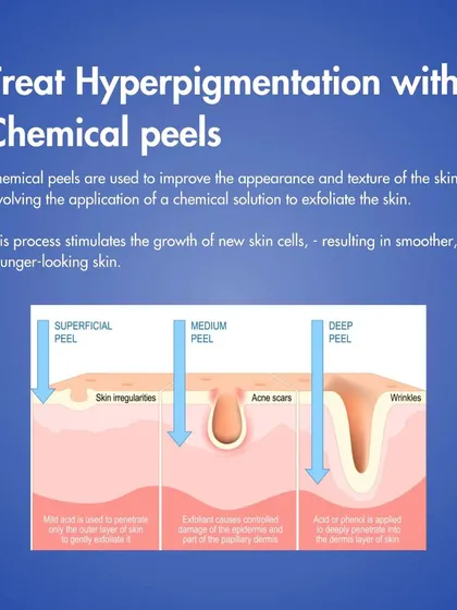 A chemical peel is an excellent treatment for hyperpigmentation. This diagram shows how a peel works at different depths to exfoliate the skin, stimulate new cell growth, and reveal a smoother, more even-toned complexion.