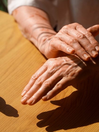 For arthritis, my Ayurvedic treatment addresses the root cause: aggravated Vata dosha. I use anti-inflammatory herbs like Guggulu and Turmeric, along with therapies like oil massage (Abhyanga) and steam (Swedana). This approach helps reduce swelling, improve joint movement, and provides sustainable relief without side effects.