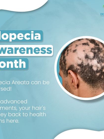 It's important to know that Alopecia Areata can often be reversed. With advanced treatments, we can help you on your journey back to hair health.