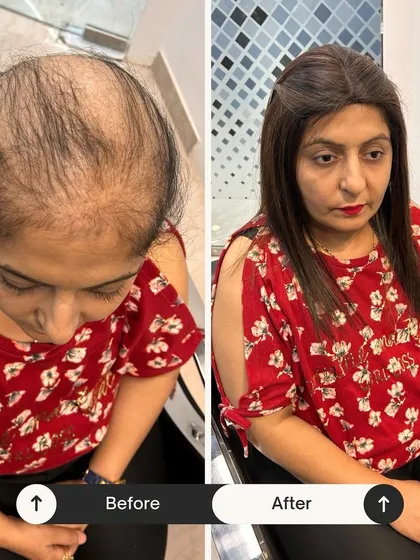 Dekhiye the difference a simple hair topper can make. For clients experiencing thinning on the crown, a high-quality topper blends in perfectly, providing instant volume and a seamless finish. It’s a small change that makes a huge impact on your daily confidence.