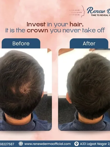 Investing in your hair is investing in the crown you wear every day. This before and after photo shows the incredible difference our combination treatments can make, restoring not just hair, but also confidence.