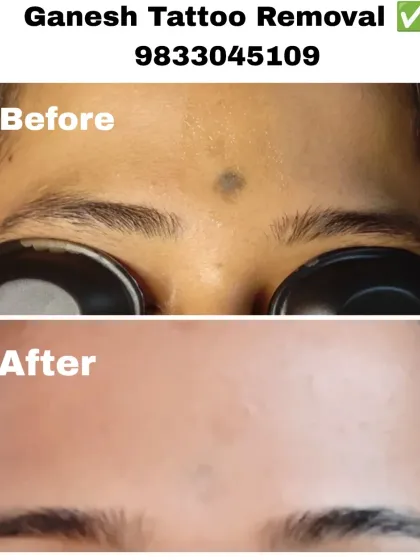 Another successful forehead tattoo removal. Notice the protective goggles worn in the 'before' shot, which are standard for any work near the eyes.