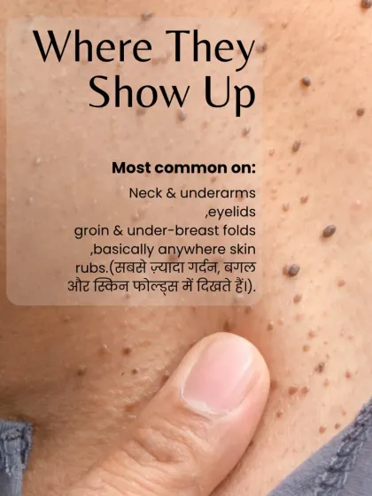 Skin tags commonly appear in areas of friction, like the neck, underarms, and other skin folds. This visual shows the typical locations where I see and treat these benign growths.