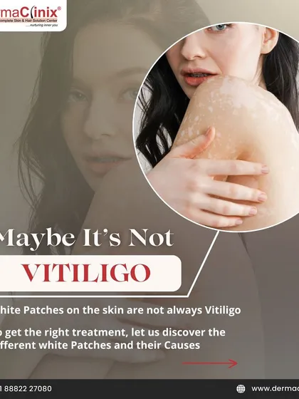 This series helps differentiate between Vitiligo and other conditions that cause white patches on the skin. Getting the right diagnosis is the first step to effective treatment.