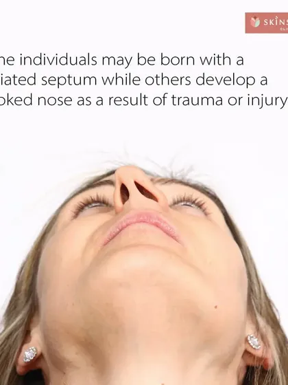 A deviated septum is very common and can result from genetics or injury. Over time, it can worsen breathing difficulties and affect the nose's external appearance, making it a functional reason to consider a septorhinoplasty.
