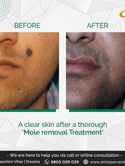 Another example of a successful mole removal treatment. This procedure helps patients who feel their appearance is affected by such growths, providing a safe way to achieve clear skin.