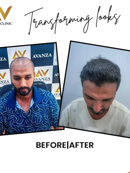 A life-changing result. This client went from being fully bald on top to having a stylish, dense hairline and full coverage. This is a permanent solution that restores confidence.
