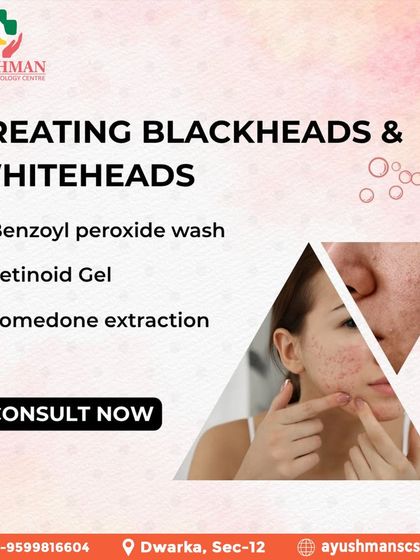 I treat blackheads and whiteheads using proven methods like Benzoyl peroxide washes, Retinoid gels, and professional comedone extractions for clear, unclogged pores.