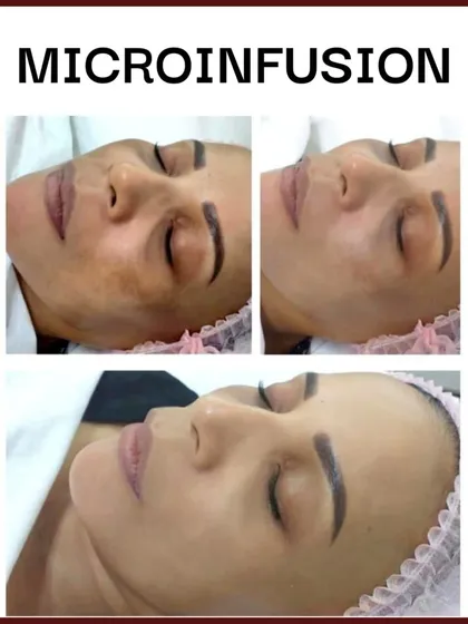 This collage shows the progression of a microinfusion treatment for facial pigmentation. The result is a smoother, more even-toned complexion, demonstrating how this technique can restore skin clarity.