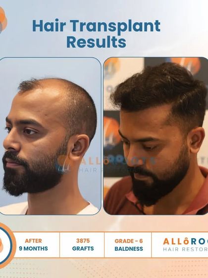 This 9-month result for a Grade 6 baldness case, achieved with 3875 grafts, is a testament to what is possible even in advanced stages of hair loss. The transformation is comprehensive and natural.