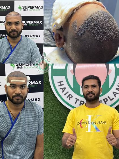 From baldness to a glam look in just 6 months. This collage details the entire process, from consultation to the final result.