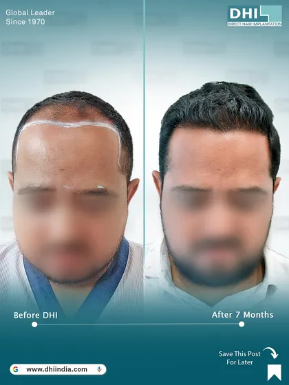 A frontal before and after of a Norwood Grade III patient, 7 months post-procedure. The restored hairline and increased thickness are clearly visible, showcasing a complete and natural-looking transformation.