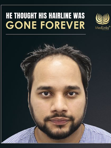 Another view of the patient's hairline before the transplant, showing the significant recession he was concerned about.