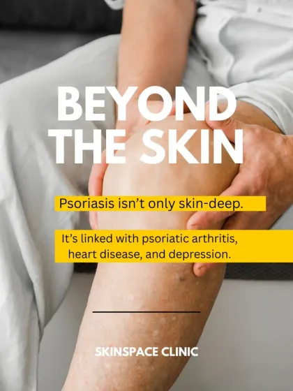 Psoriasis is a systemic condition, meaning it is not just skin-deep. It is linked with other serious health issues like psoriatic arthritis and heart disease, which is why comprehensive medical management is vital.