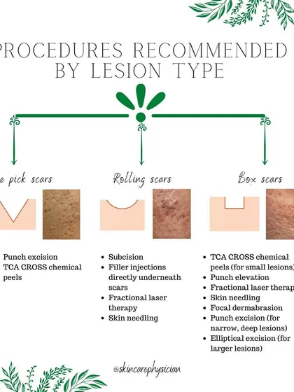 Understanding your specific type of acne scar is the first step toward effective treatment. This guide shows the different procedures I recommend for ice pick, rolling, and boxcar scars, allowing us to create a targeted plan together.