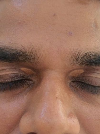 A before-photo of a patient with Xanthelasma on both eyelids. These yellowish deposits are effectively and safely removed with laser treatment.